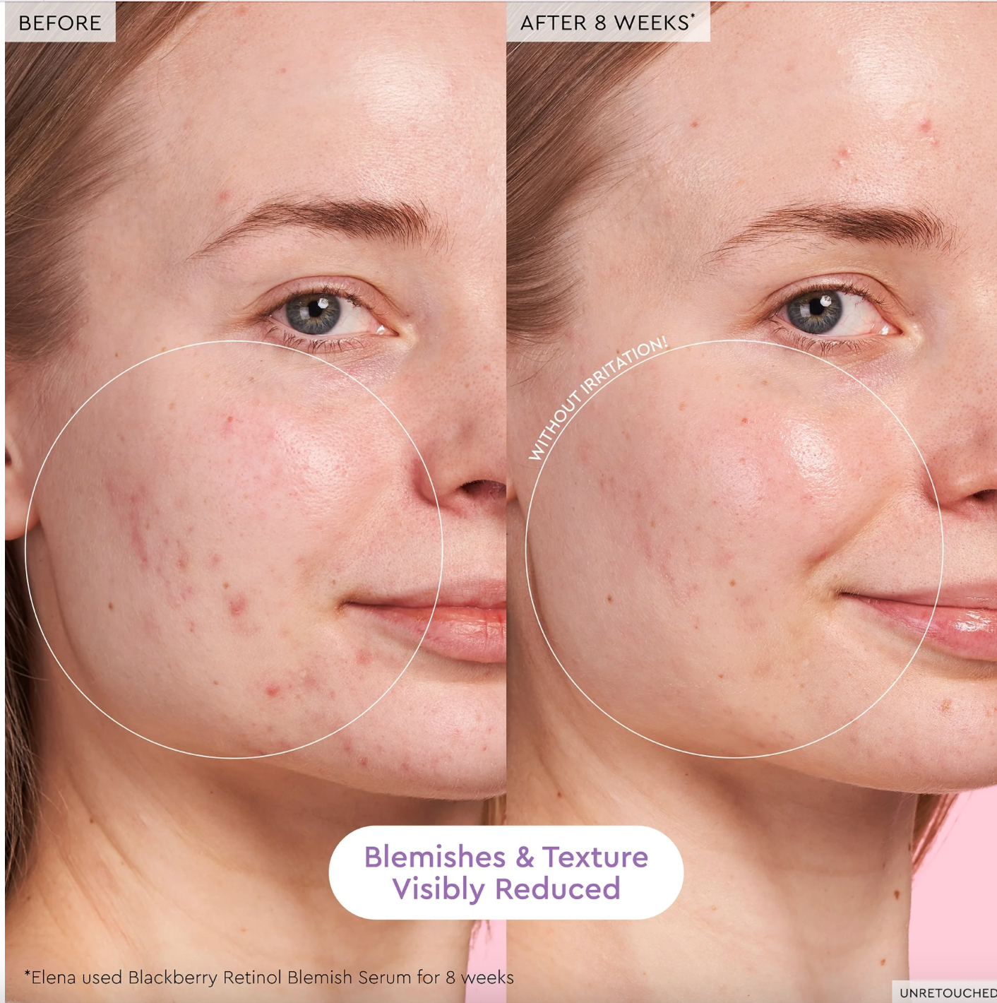 Серум із ретинолом Blackberry Retinol Blemish Serum
